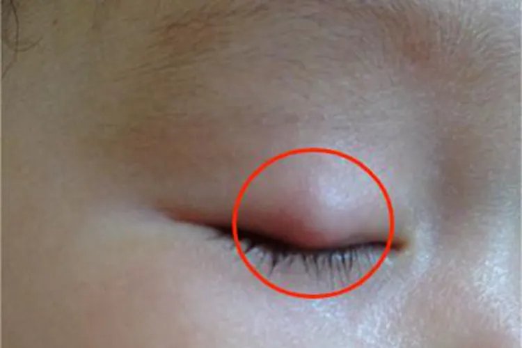 皮脂腺上皮瘤眼睑结节图片