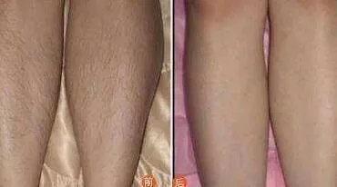 腿部脱毛价格
