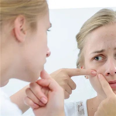 脸上长痤疮是什么原因