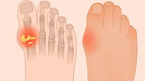 尿酸高会引起肌酐高吗