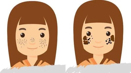 什么叫黄褐斑，雀斑，有什么分别吗？