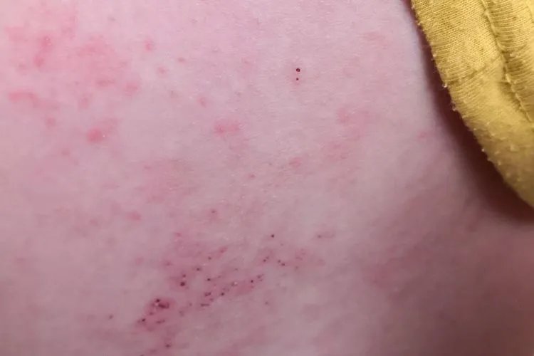 水疱疹图片
