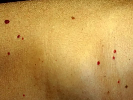 肝血管瘤的表现症状