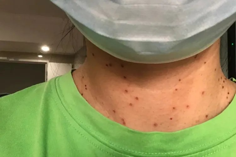 瘊子激光后恢复过程图