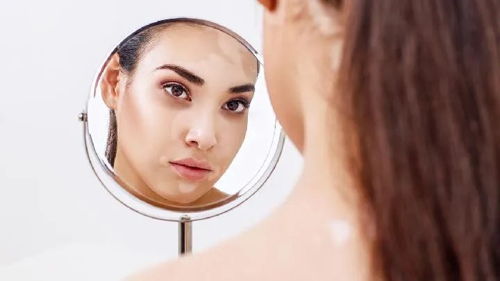 白癜风是什么皮肤病呢