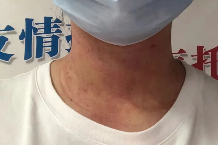 瘊子激光后恢复过程图