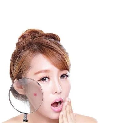 青春痘印怎么治疗