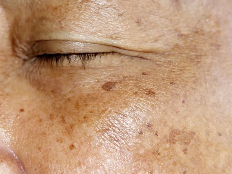 黄褐斑怎样治疗