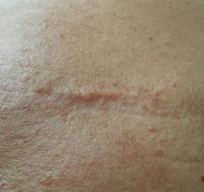 疤痕性皮肤图片