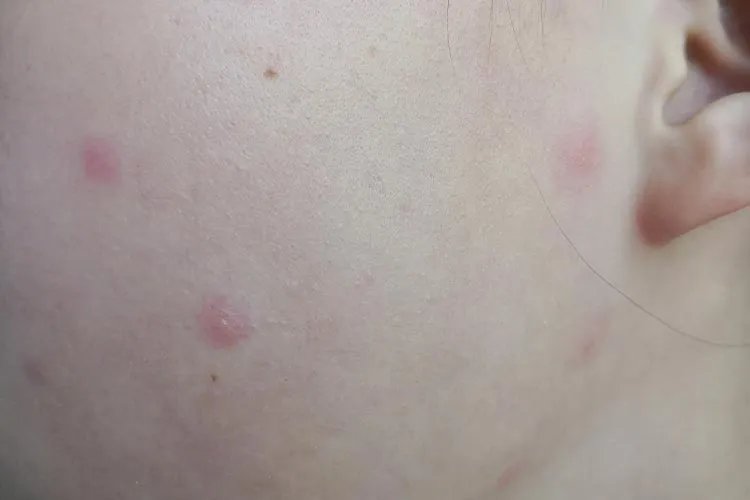 水痘的症状和治疗图片