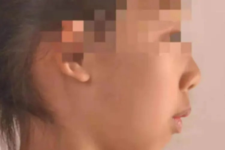 13岁娃腺样体肥大面容照片