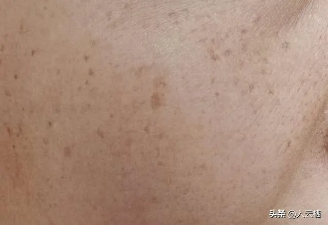 什么叫黄褐斑，雀斑，有什么分别吗？