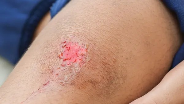 一年吃一次毓婷会有很大伤害吗 不要步入口服避孕药的误区