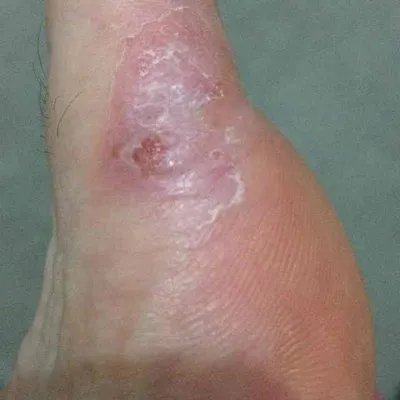 怎样治疗鹅口疮？