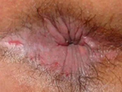 蛲虫病肛门裂口图片