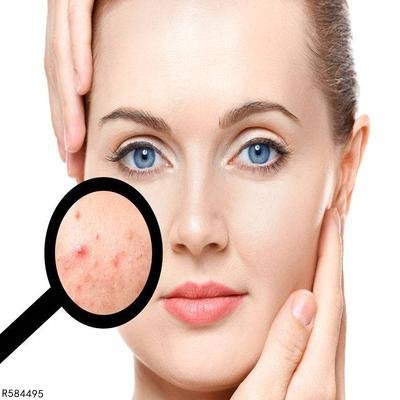 脸上长白头粉刺怎么办 掌握五大方法快速去除白头粉刺