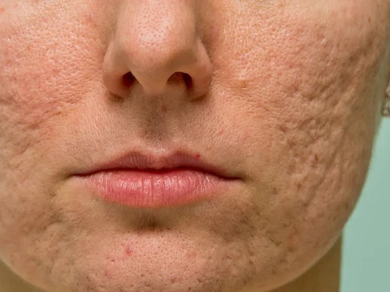 治疗痘坑的方法