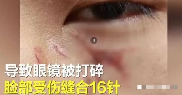 陕西 15 岁男生遭老师殴打缝 16 针，是否构成故意伤害罪？