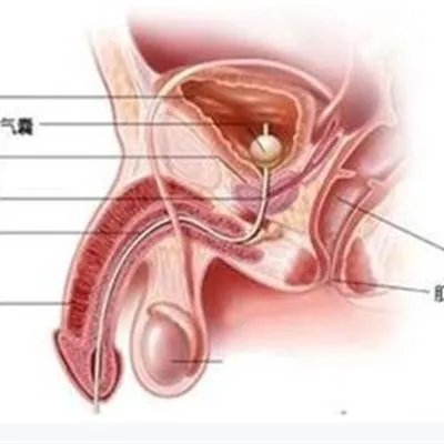 阴茎畸形有哪些?