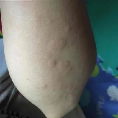 出麻子是什么症状