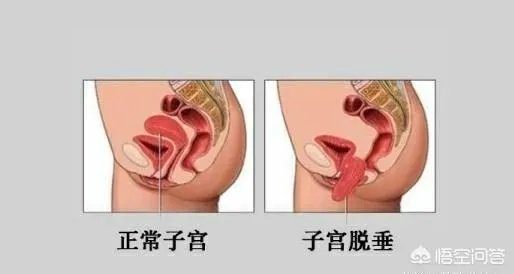 最近，我们最爱的Ella曝出产后膀胱脱垂、尿失禁，宝妈有什么方法可以进行恢复？