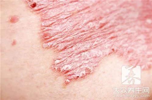 羊蹄根白糖治疗牛皮癣，告诉你详细方法步骤