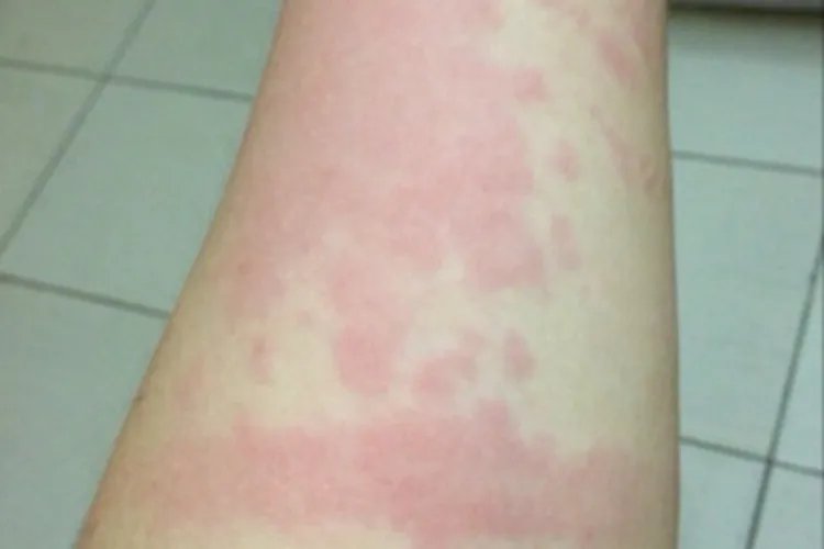 海鲜过敏症状图片