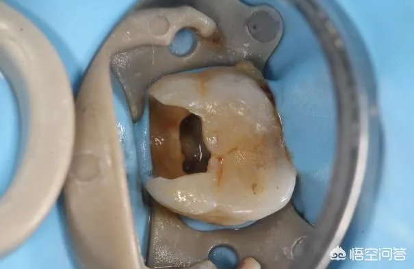 被虫蛀的牙只能拔掉吗