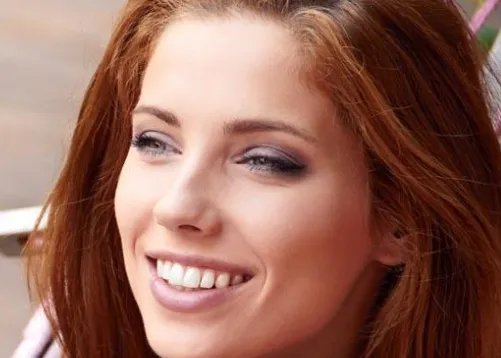 激光去黄褐斑好处