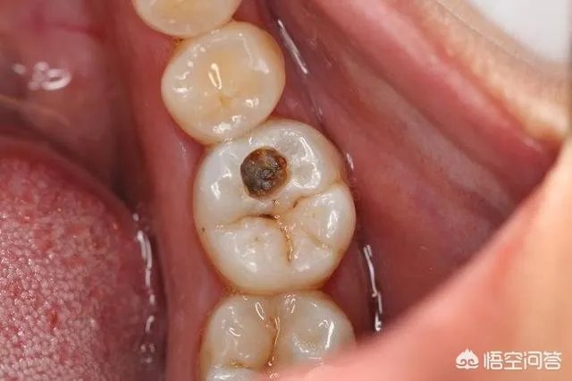被虫蛀的牙只能拔掉吗