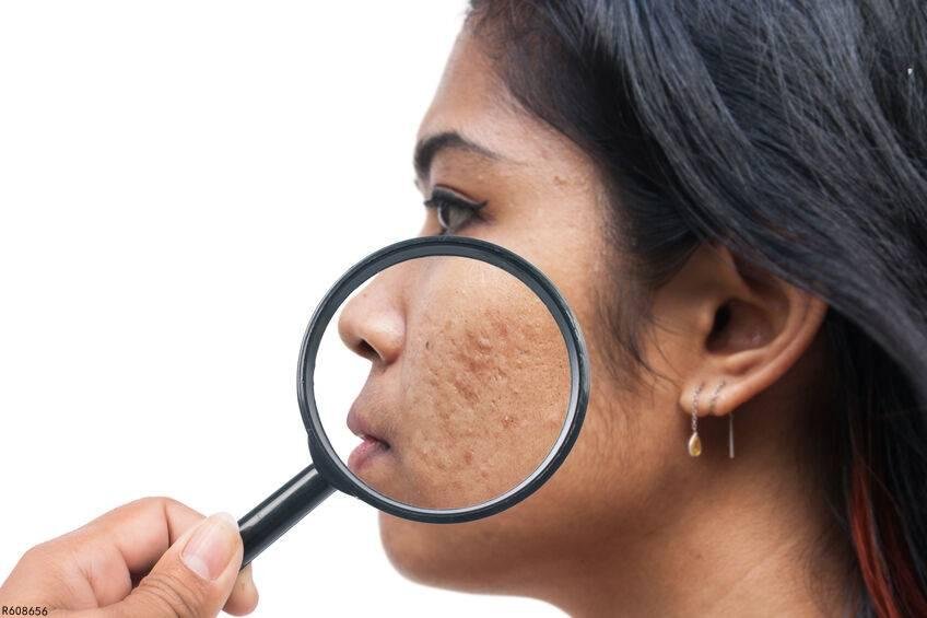 自己怎么祛痘坑