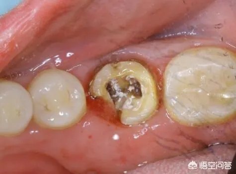 被虫蛀的牙只能拔掉吗