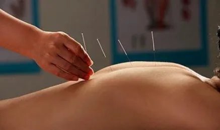 针灸减肥好吗？为什么？