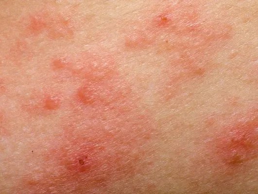 急性荨麻疹的治疗