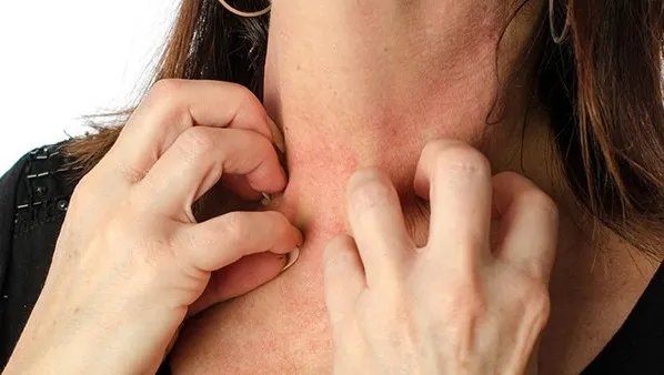 急性荨麻疹有哪些症状