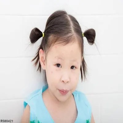 宝宝被蚊子咬后的正确处理方法有哪些