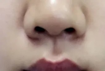 鼻孔大怎么办才好