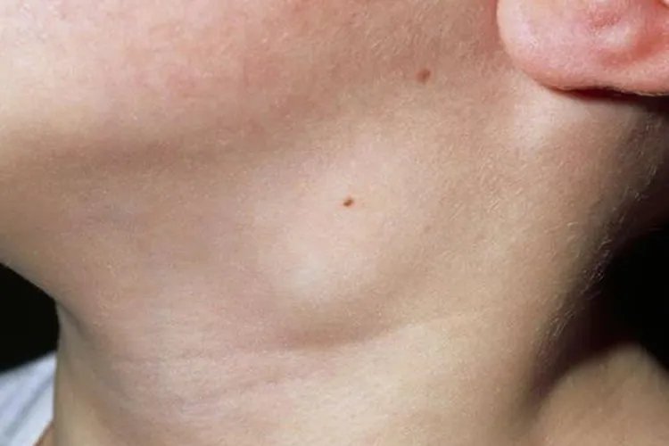 淋巴癌的早期症状图