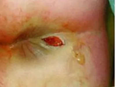 蛲虫病肛门裂口图片