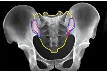 骶髂关节mr影像图