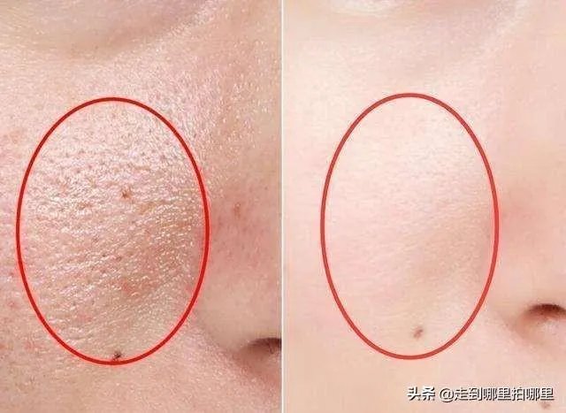 怎样祛痘坑？