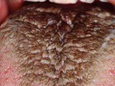 黑毛舌黑痂图片