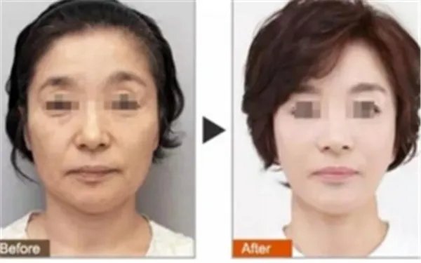 注射玻尿酸多少钱?