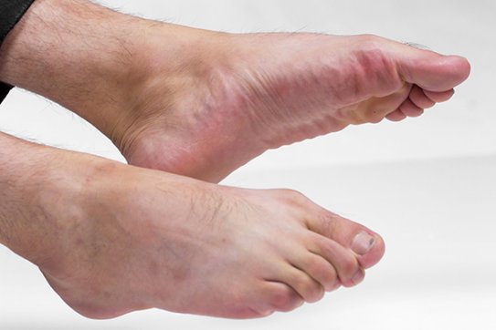 扁平足的矫正方法有哪些