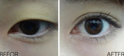 割双眼皮手术多长时间恢复