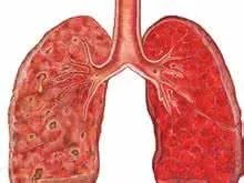 肺间质性纤维化的症状？