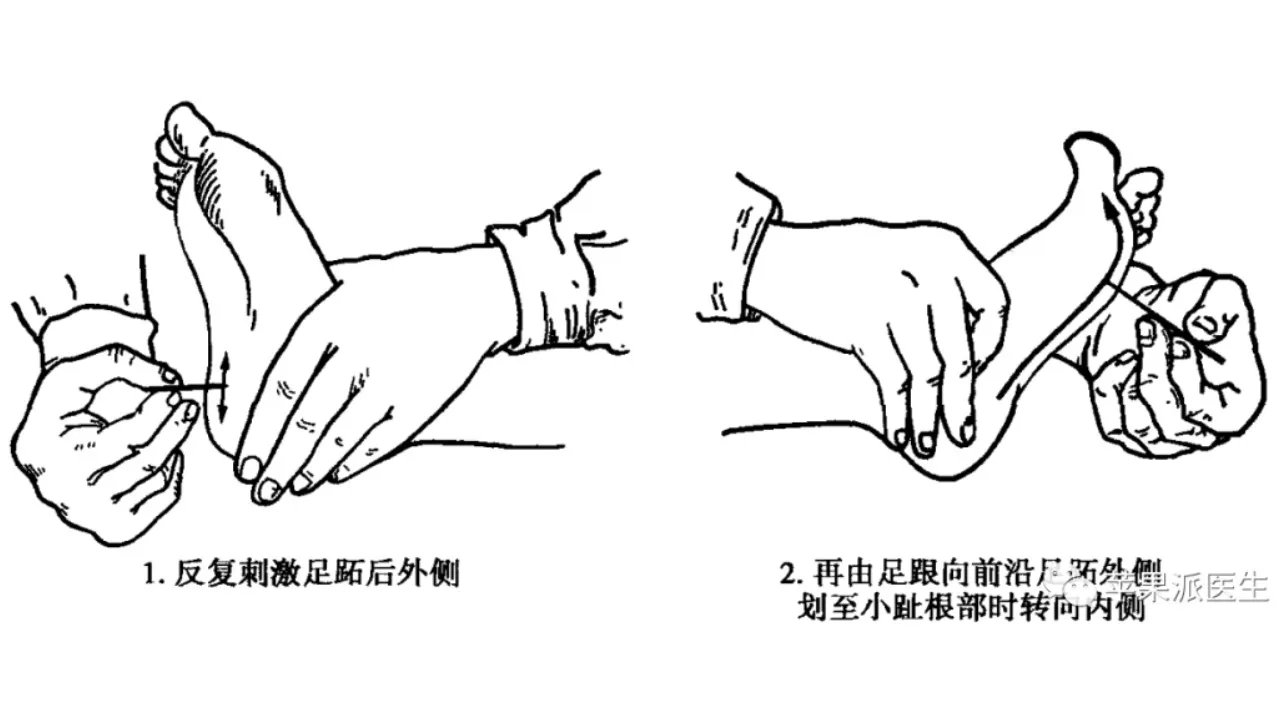 理解Babinski征,划对Babinski征