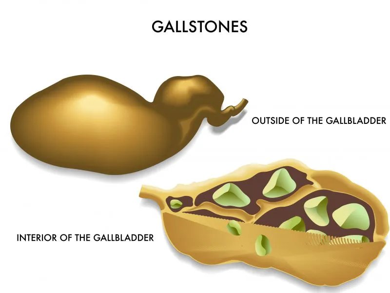 胆囊切除后遗症