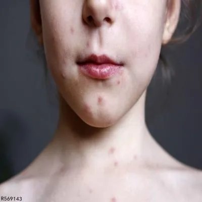 下巴长痘痘怎么回事 下巴长痘痘的三个原因你知吗