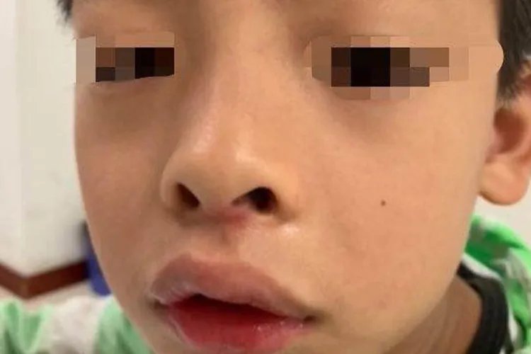 13岁娃腺样体肥大面容照片